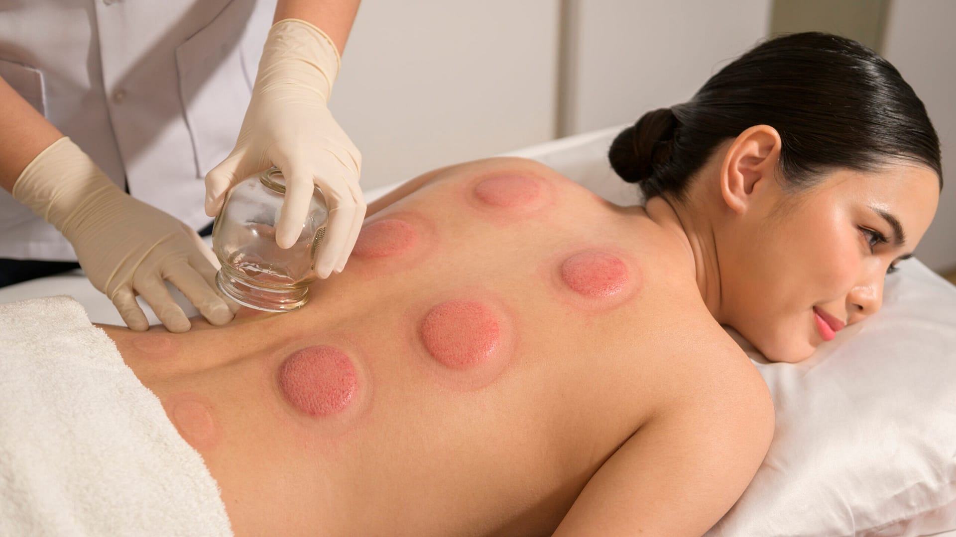 Woman Received cupping treatment on back by therapist