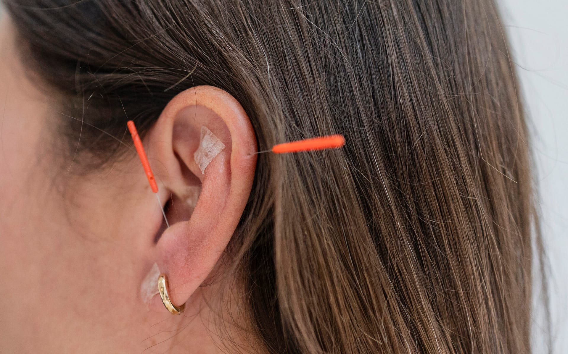 Woman receiving ear acupuncture treatment for wellness