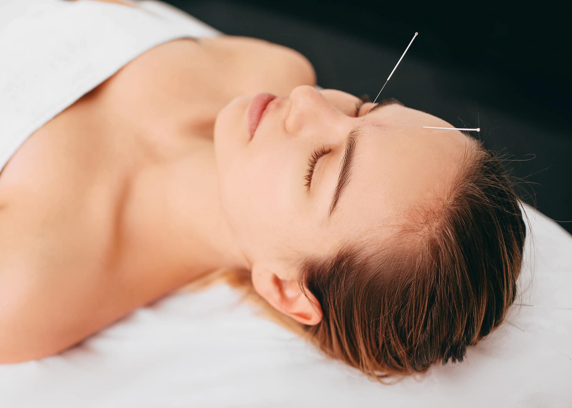 beautiful woman with acupuncture needles on her face